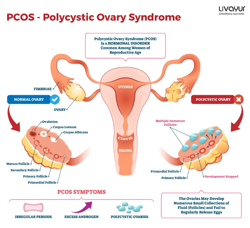 Fight PCOS & Prevent PCOS Complications With These Ayurvedic Herbs