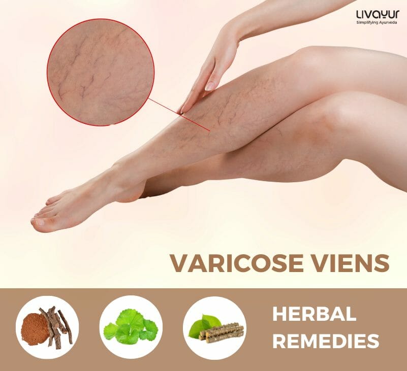 Traditional Ayurvedic Treatment for Varicose Veins