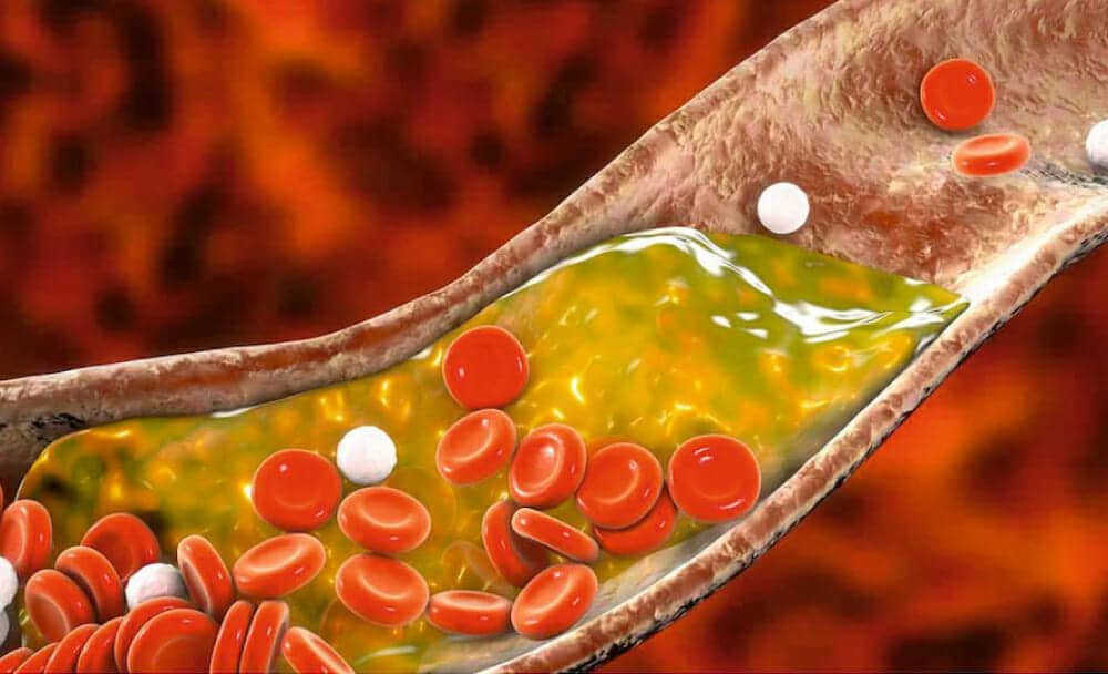 Get Your Cholesterol Under Control With Guggulu