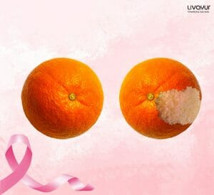 Breast Cancer : Symptoms,Causes,Diagnosis, Prevention & Treatment