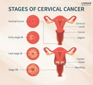 What is Cervical Cancer: An Overview, Symptoms, Causes, Diagnosis, Prevention & Treatment