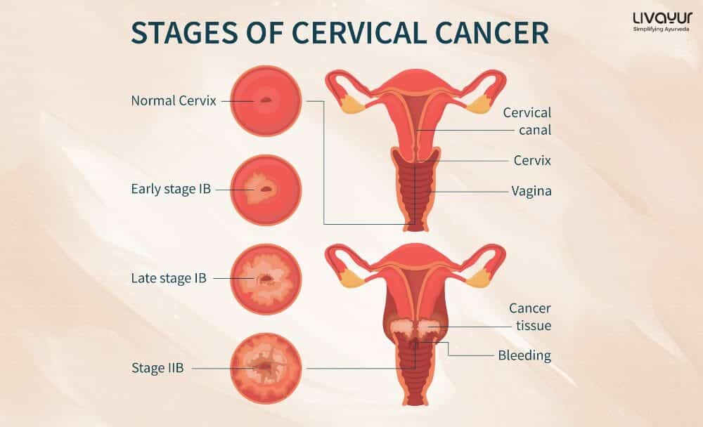 Cervical Cancer Cervical Cancer