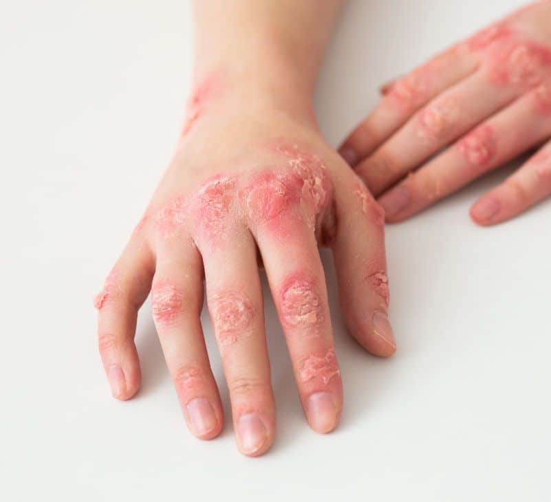 What is syphilis - Livayur