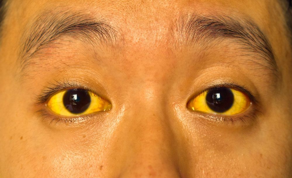 What is jaundice - livayur