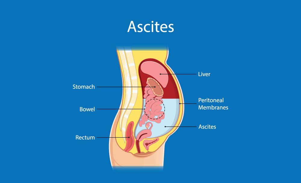 ascites symptoms - abdominal swelling