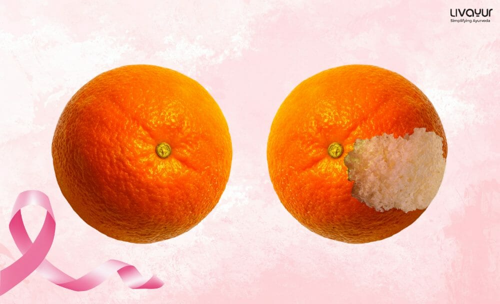 (in-article image)Breast Cancer in article imageBreast Cancer