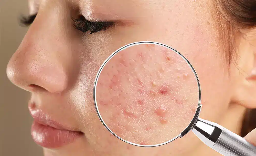 acne treatment