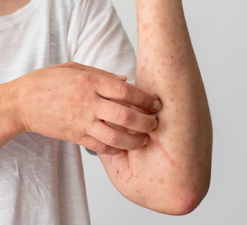skin rash - livayur
