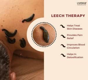 Leech Therapy: What it is, Benefits, Side Effects & How it’s Done