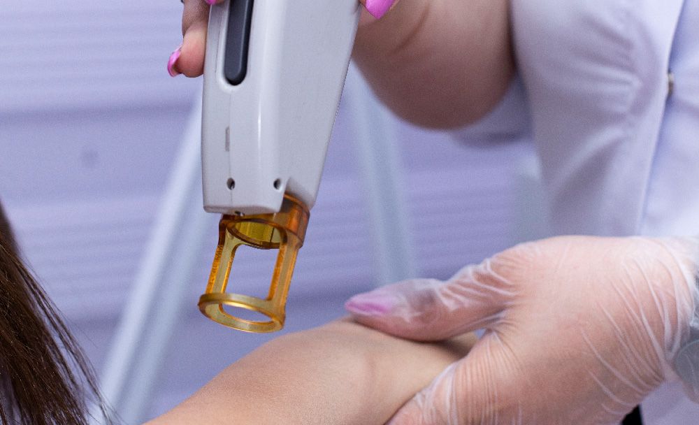 leucoderma treatment - excimer laser therapy