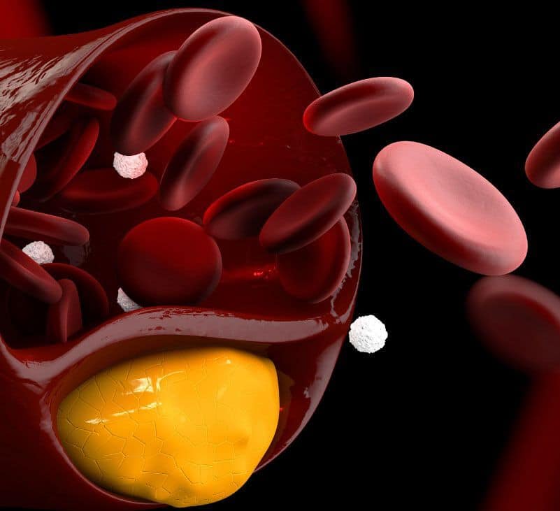 hypercholesterolemia - livayur