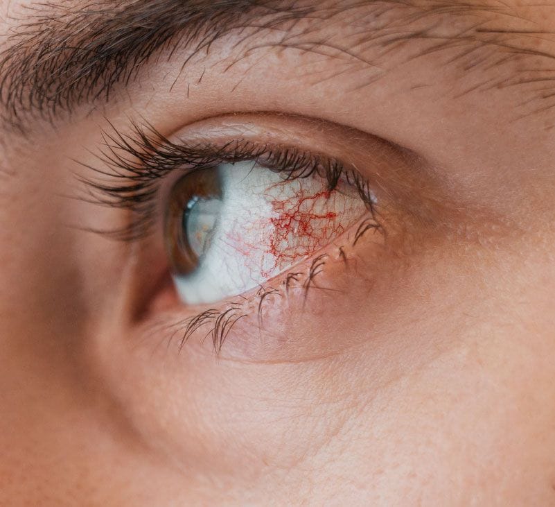 conjunctivitis - livayur