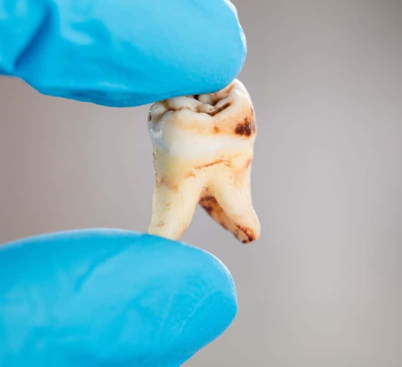 tooth decay - livayur