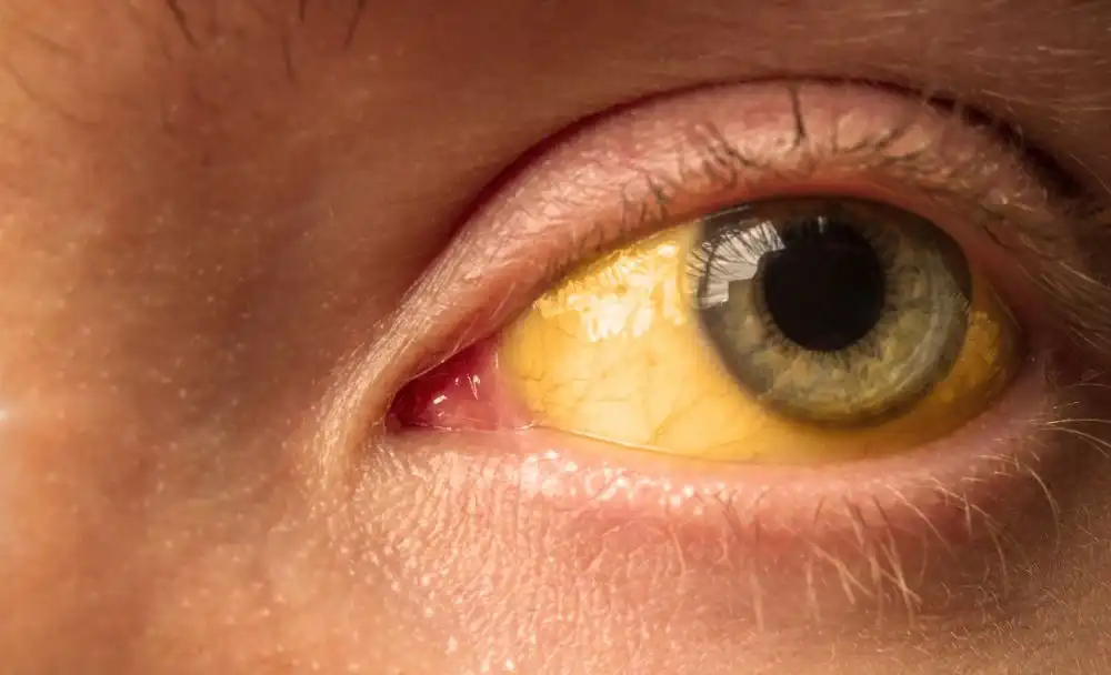 8 पीलिया के लक्षण इलाज