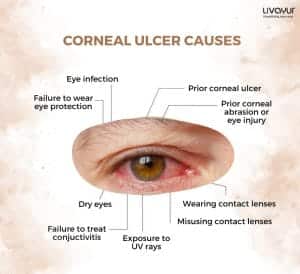 Corneal Ulcer: What Is It, Causes, Symptoms & Treatment