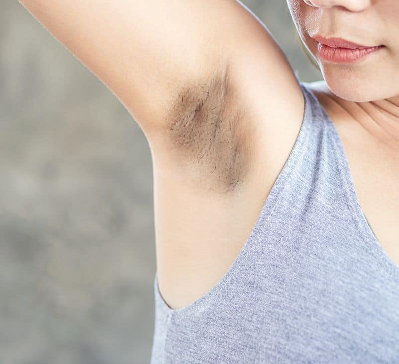 dark underarms - livayur