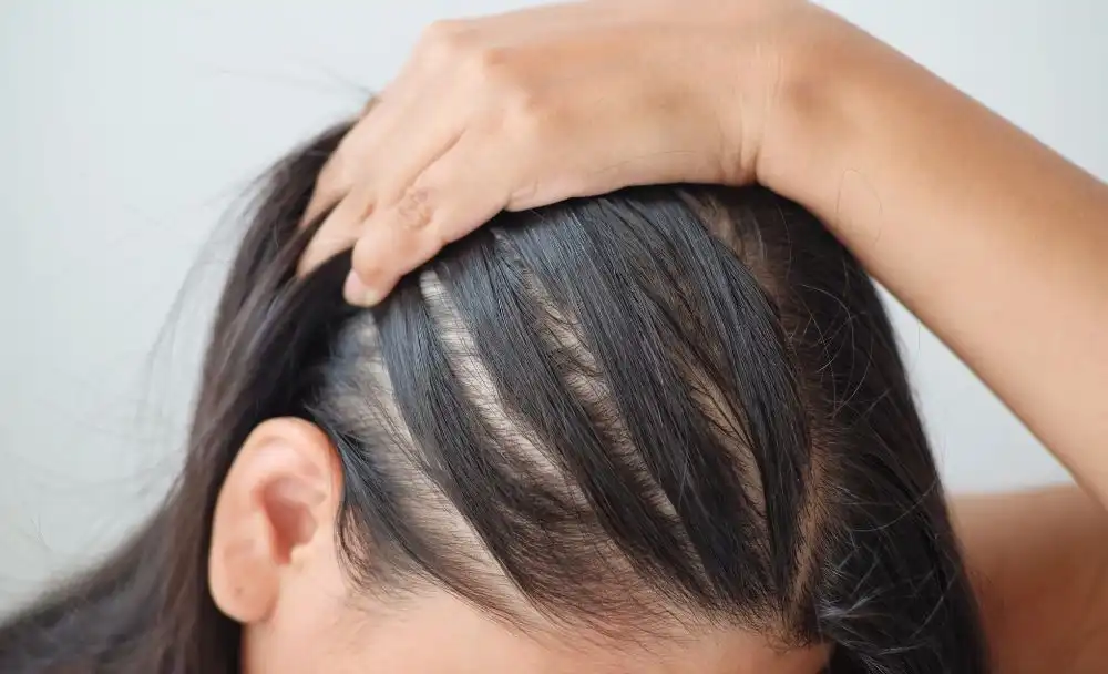 10(1) Hair fall Treatment