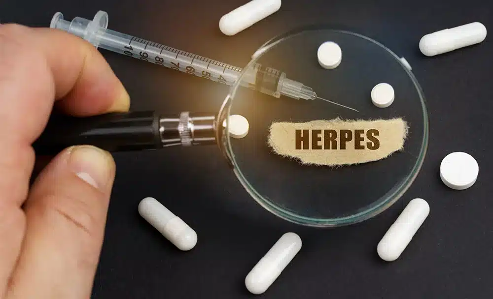 36-1000-X-608px Herpes Symptoms