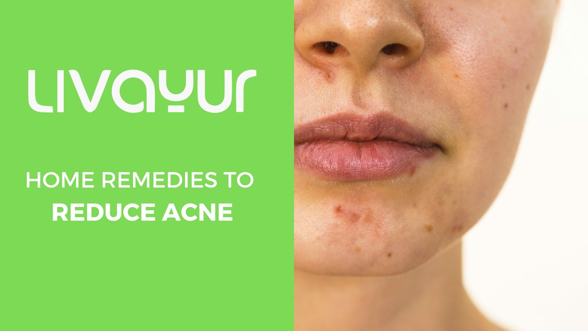 Ayurvedic Home Remedy for Acne Free Clear Skin Thumbnail
