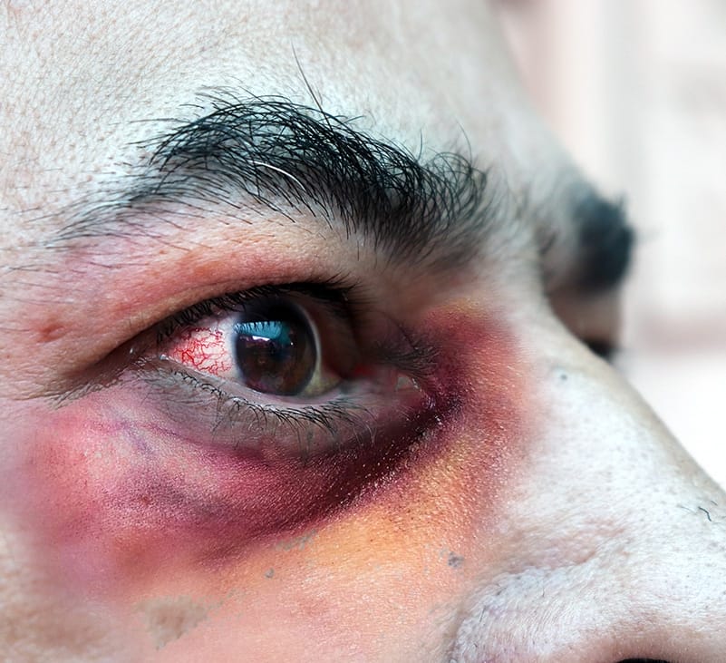 black fungal symptoms - livayur