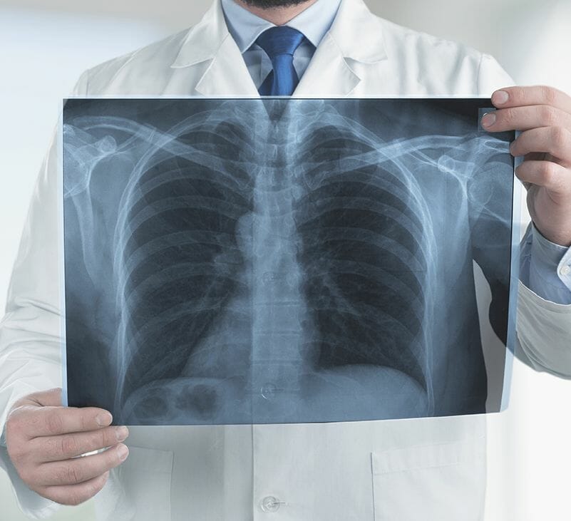 cystic fibrosis