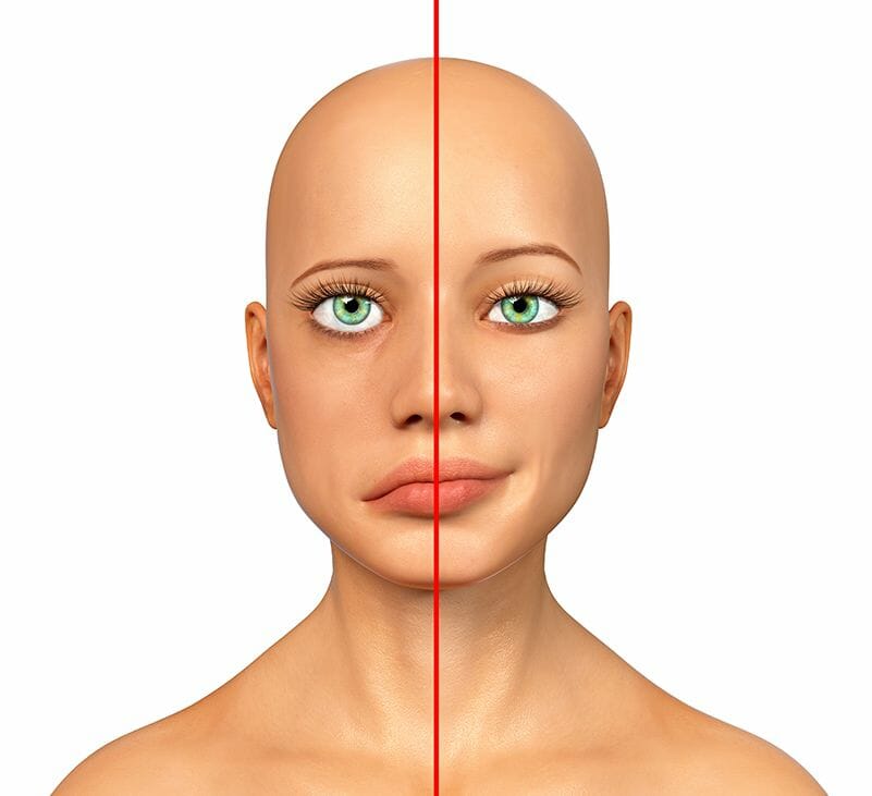 bell's palsy treatment