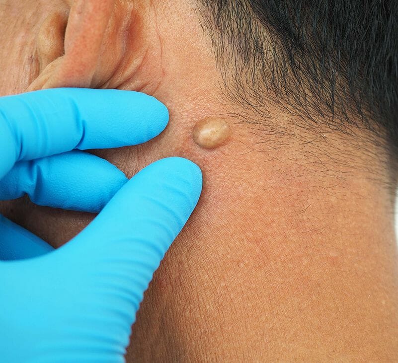 lipoma meaning - livayur