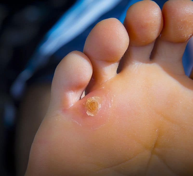 corn on foot - livayur