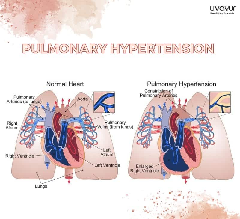 Pulmonary Hypertension: Symptoms, Causes,Diagnosis & Treatment
