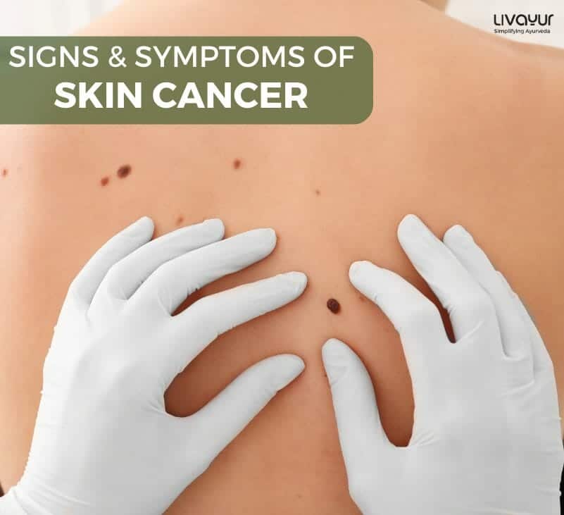 Skin Cancer: Symptoms, Causes, Types, Stages, Treatment & More   