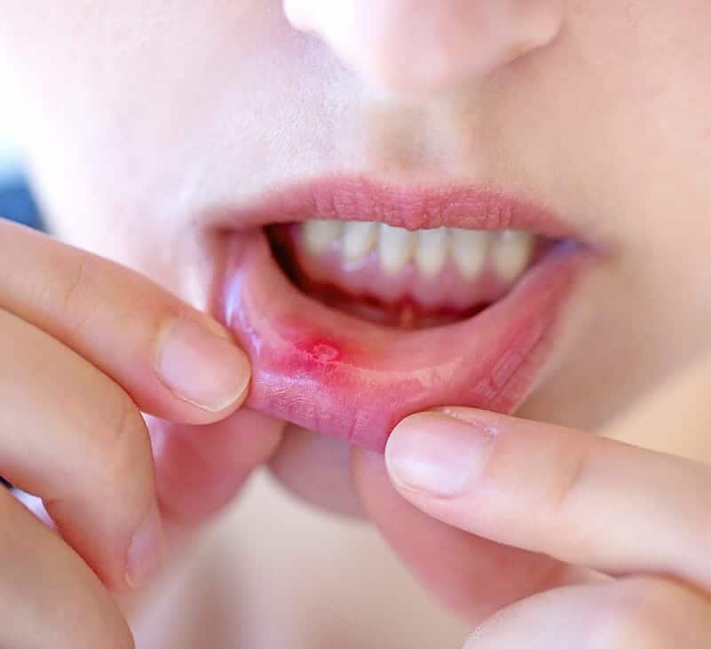 stomatitis - livayur