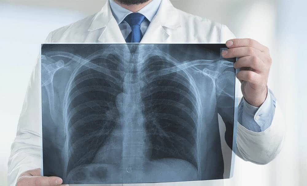 cystic fibrosis