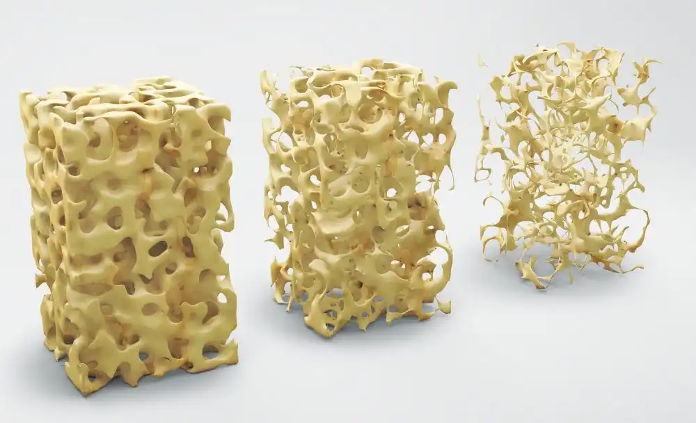 1(1) Osteoporosis treatment