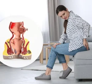 Female Haemorrhoids: Causes, Symptoms, Diagnosis, Treatment & More