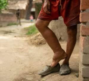 Elephantiasis: Symptoms, Causes, Treatment & More
