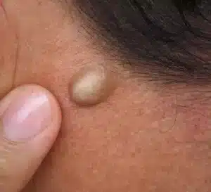 Lipoma causes: What are the Causes of Lipoma