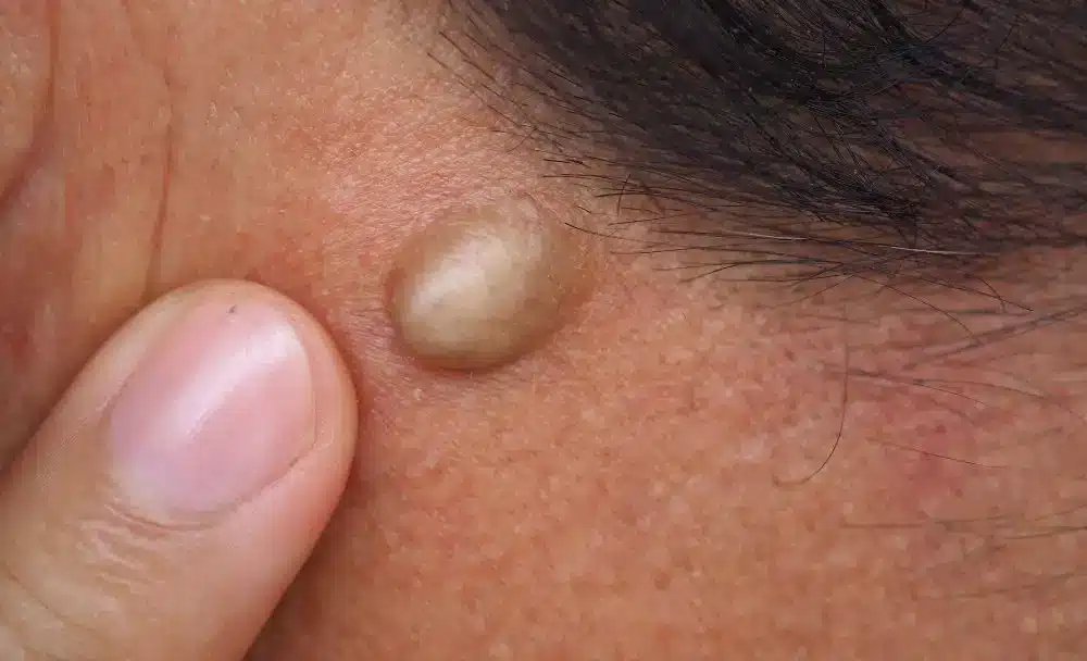 3(1) lipoma causes