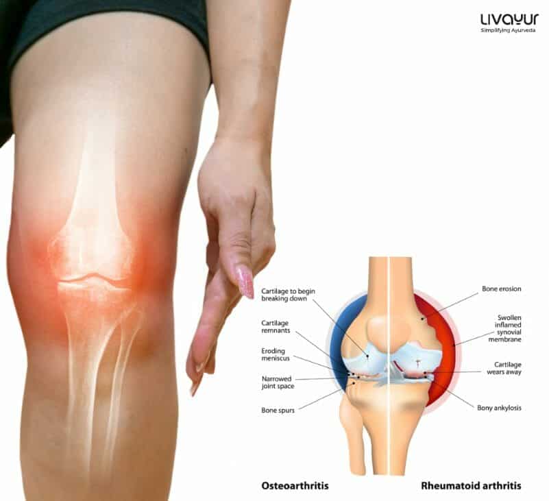 Ayurvedic Medicines, Treatments and Remedies for Joint Pain