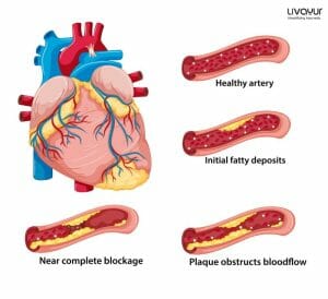 Can Ayurveda Help in Curing Coronary Heart Disease?