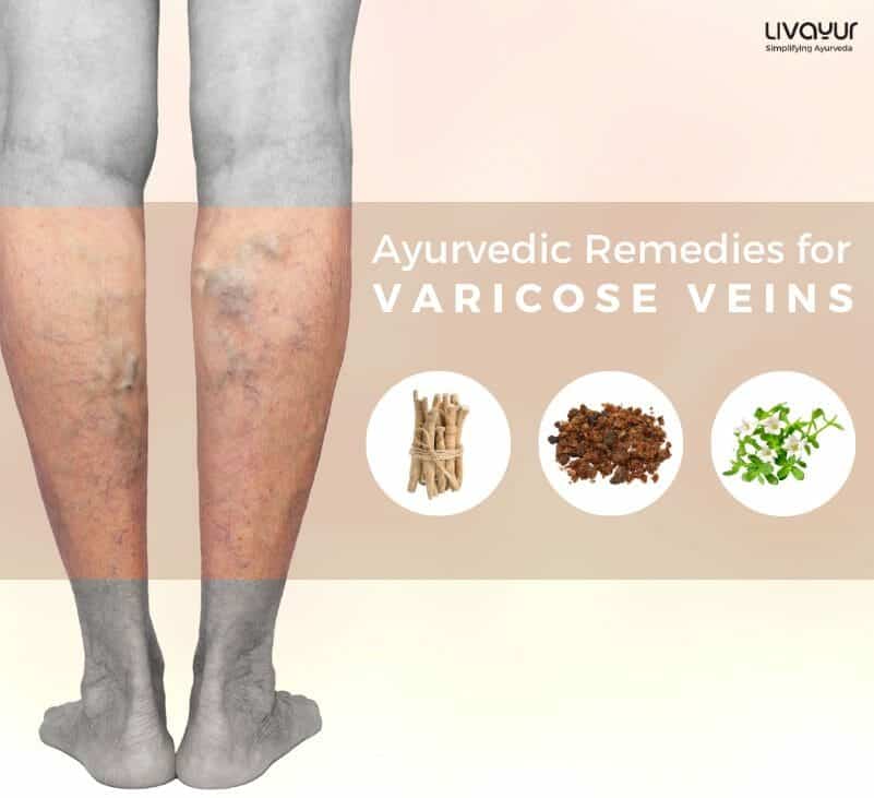 Try Ayurvedic Treatment for Varicose Veins for Quick Relief