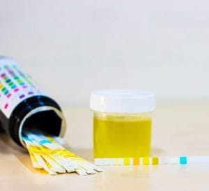 Glycosuria: Symptoms, Causes, Types, Diagnosis and Treatment