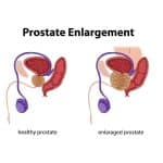 what is prostatomegaly - livayur
