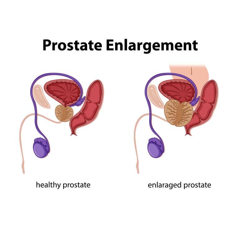 what is prostatomegaly - livayur