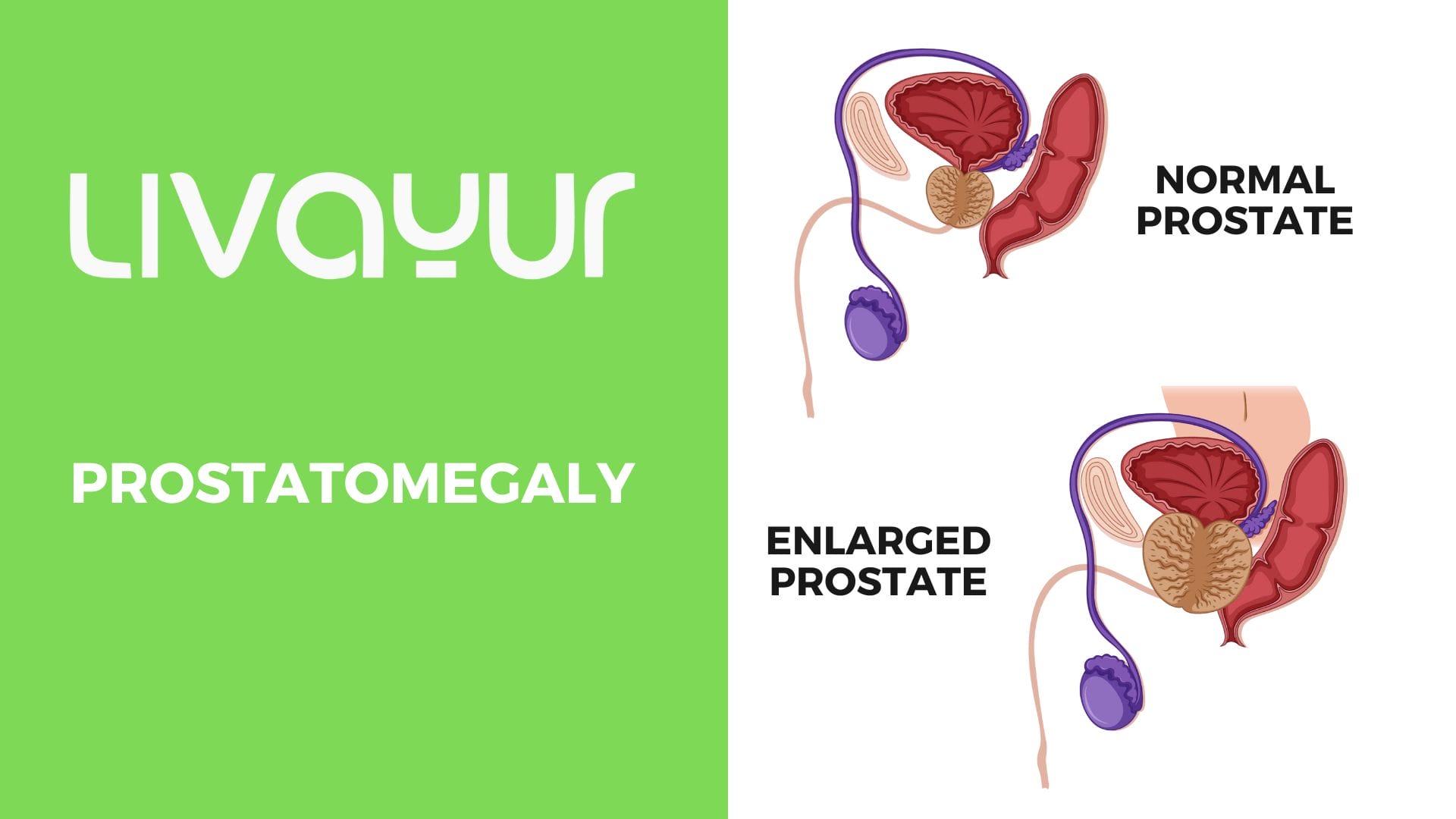 Prostatomegaly Management: Ayurvedic Herbs, Yoga Asanas & More Thumbnail