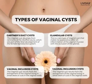 Vaginal Cyst: Causes, Symptoms, Types, Treatment & More