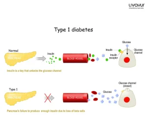 Type 1 Diabetes: Symptoms, Causes, Risk Factors & Treatment